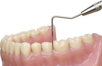 歯周病（歯槽膿漏）・予防歯科